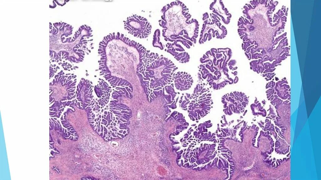 Low grade яичников. Webpathology фиброма яичника.