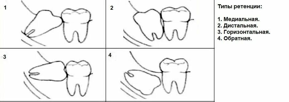 Лечение зуба 8. Дистопированный зуб мудрости верхний. Ретенция зубов мудрости. Ретинированный зуб мудрости Нижний. Удаление ретенированного зуба мудрости.