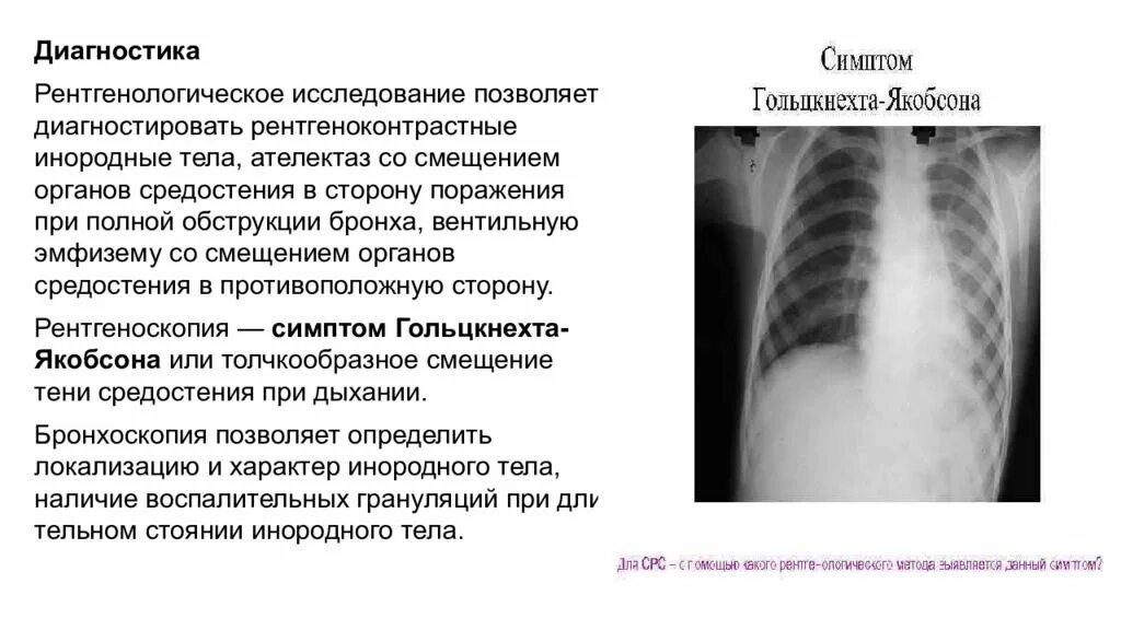 Инородные Тела Трахеи Бронхов