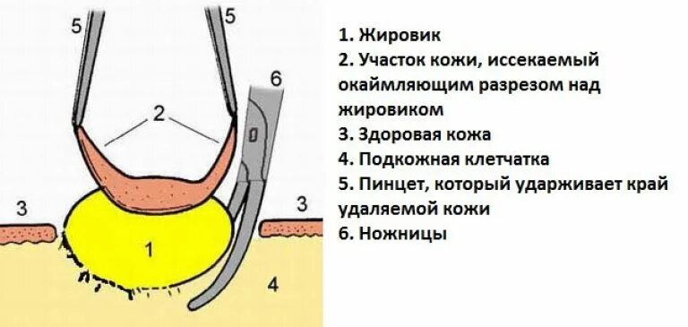 Атерома волосяного фолликула. Липома жировик подкожный. Жировик средства лечения