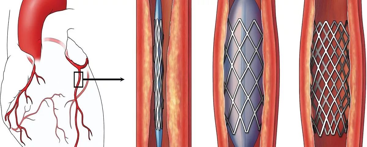Операция стентирование сосудов сердца. Стентирование сосудов коронарных артерий. Что такое шунтирование сосудов сердца и стентирование. Стентирование дилатация.