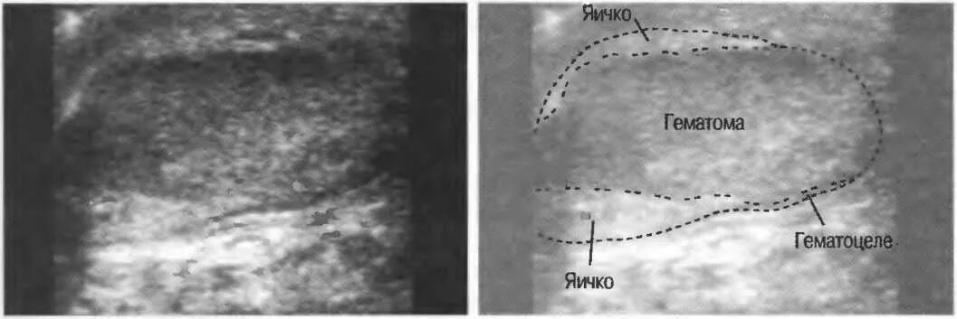 Гематома придатков яичка УЗИ. Гематома яичка на УЗИ эхограммы. Гематома в стадии организации