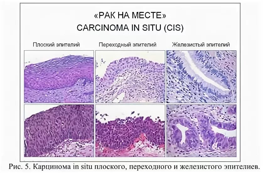 Интраэпителиальная карцинома. Карцинома in situ микропрепарат. Интраэпителиальная карцинома слизистой. Карцинома in situ шейки матки. Рак in situ шейки