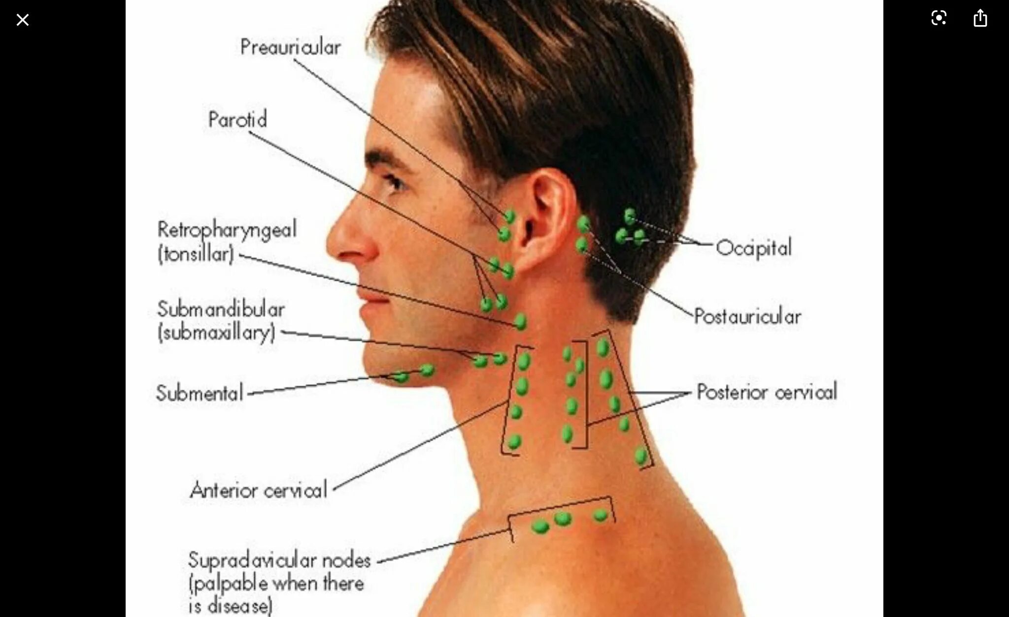 Регионарные шейные лимфоузлы. Воспаленный затылочный лимфоузел. Надключичные лимфоузлы. Лимфоузлы под ухом у человека расположение. Какой лимфоузел на ощупь