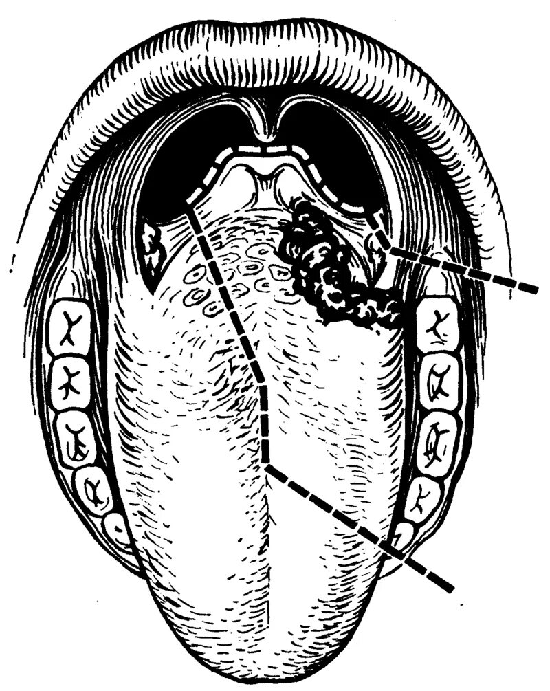 Гипертрофия сосочков корня языка. Гиперплазия язычной миндалины. Корень языка и надгортанник. Гиперплазия язычной миндалины кт.