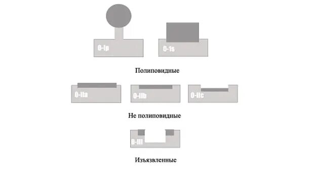 Тип 0 is. Эндоскопическая классификация полипов. Парижская классификация полипов толстой кишки. Парижская классификация эпителиальных образований толстой кишки. Классификация полипов эндоскопия.