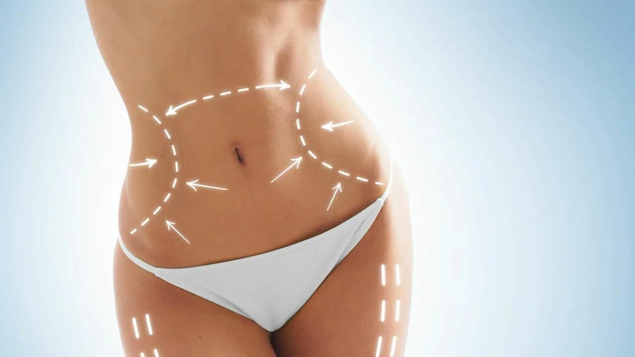 Lpg массаж живота. Abdominoplasty. Кармель абдоминопластика. Абдоминопластика от растяжек.