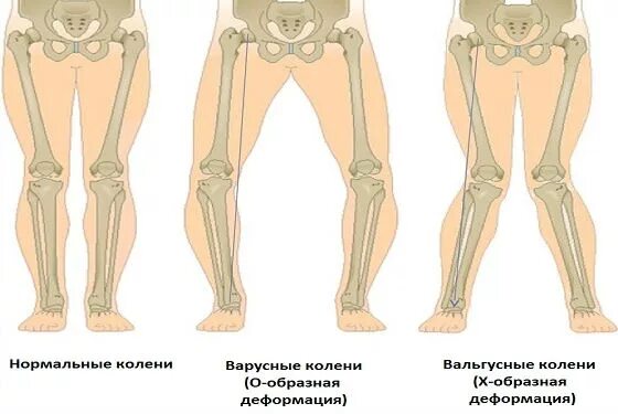 Вальгусная деформация искривление стопы. Вальгус деформация у детей. Варусная деформация большеберцовой кости. Варусная деформация коленных суставов у детей.