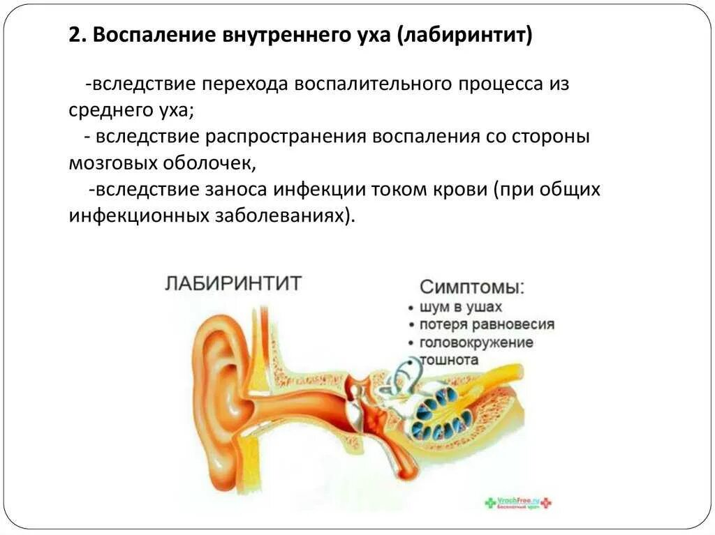 Лечение воспаления среднего уха у взрослых. Внутренний отит (лабиринтит). Заболевания внутреннего уха таблица. Воспаление внутреннего уха лабиринтит. Острый лабиринтит симптомы.