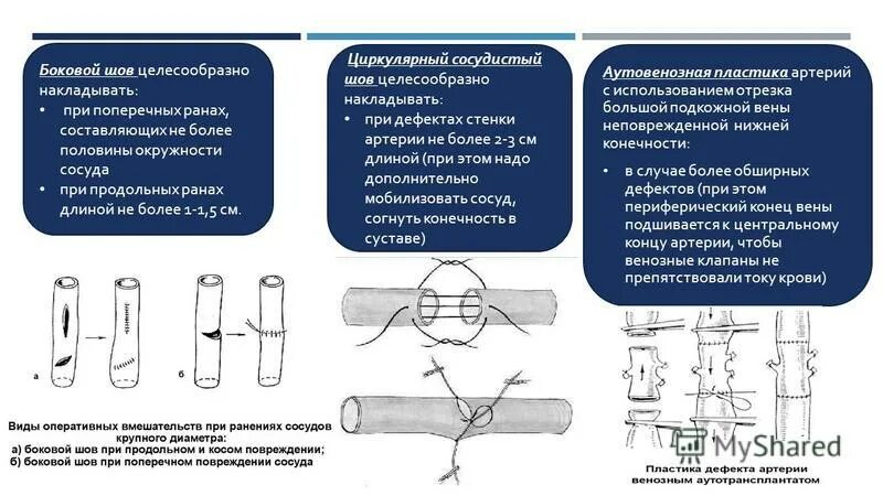 Классификация повреждений артерий. Классификация огнестрельных ранений. Аутовенозная пластика.