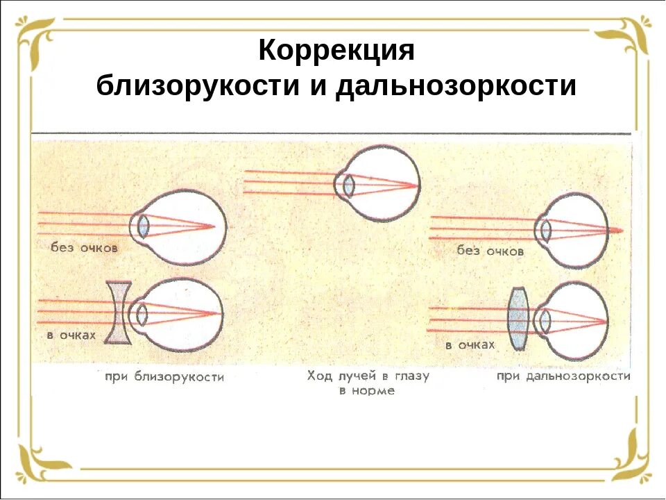 Близорукость первая помощь. Коррекция зрения близорукость и дальнозоркость. Миопия схема глаза. Строение глаза при дальнозоркости. Близорукость и дальнозоркость схема биология.