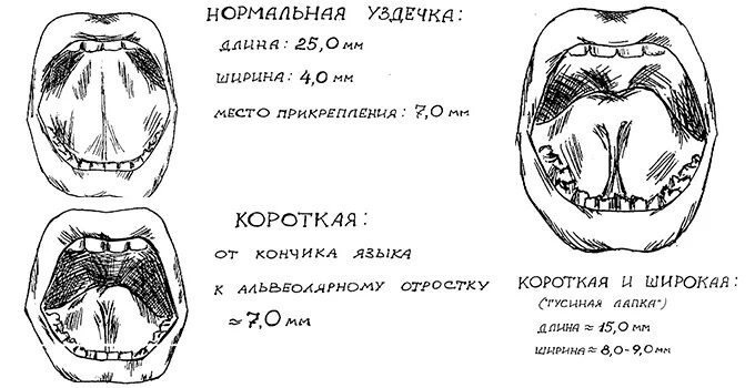 Подъязычная уздечка норма и патология. Стадии укорочения уздечки языка. Короткая уздечка языка и норма. Как определить уздечку у ребенка. Какой размер языка