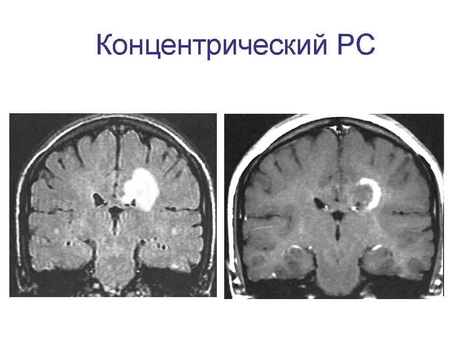 Рассеянный склероз. Поражение белого вещества головного мозга. Рассеянный склероз в белом веществе. Склероз симптомы. Рассеянный склероз побочные эффекты