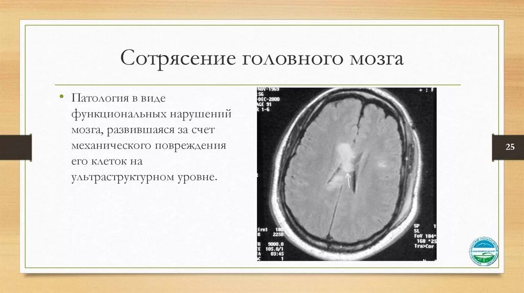 Подозрения на сотрясение. Сотрясение головного м. Сотрясени еголовоного мозга. Закрытые травмы головного мозга грудной клетки. Сотрясение мозга рентген.