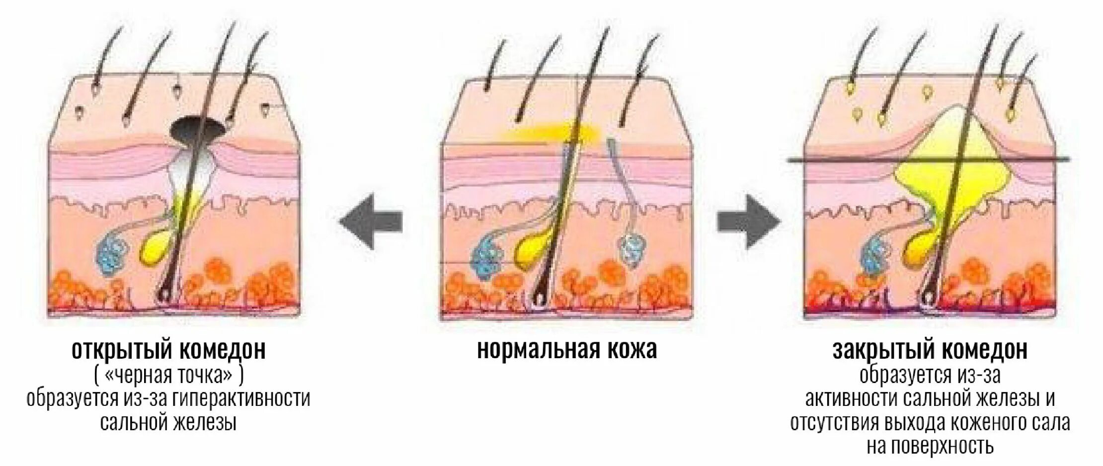 Комедоны строение кожи. Угри акне черные точки комедоны. Черные точки комедоны строение. Отличие прыщей и комедонов акне.