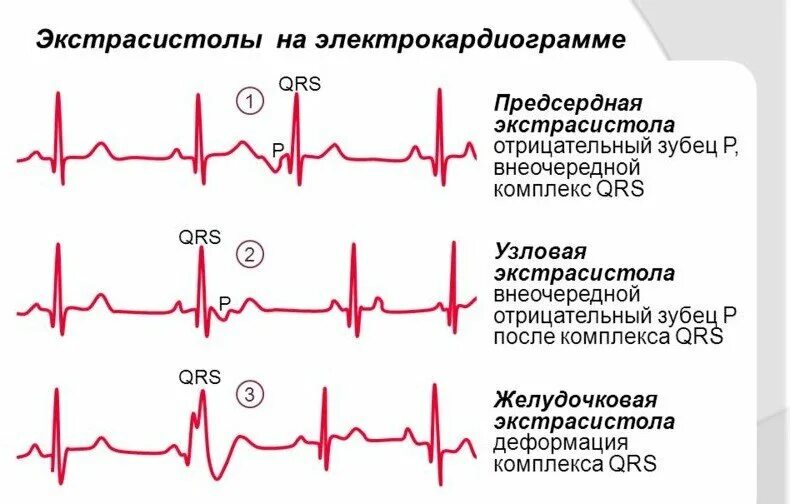 Ощущаю экстрасистолы. Желудочковая экстрасистолия примеры экг. нарушение ритма экг экстрасистолы. виды экстрасистолии на экг. желудочковые экстрасистолы на экг.