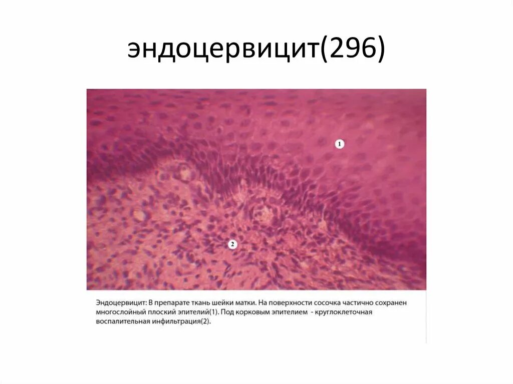 Полип шейки матки гистология. Эндоцервицит патологическая анатомия. Эндоцервикоз патанатомия. Хронический цервицит гистология. Экзоцервицит и эндоцервицит