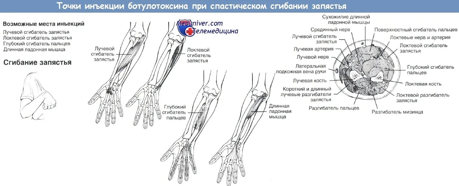 Лучевой и локтевой сгибатели запястья. Лучевой сгибатель запястья функции. Локтевой сгибатель запястья функции. Сгибание в лучезапястном суставе. Точка уколова