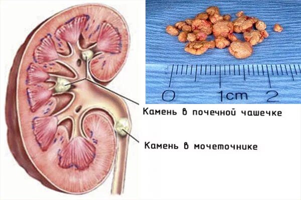 Конкремент латынь. В чашечке левой почки конкремент 7мм. Камень в лоханке почки 8мм. Камни почечной лоханки и чашечек.