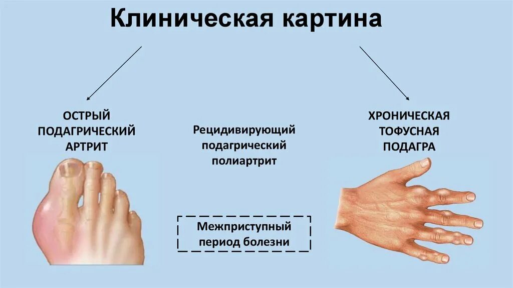 Лечение подагры клинические рекомендации. Проявления подагра клинические симптомы. Подагра клинические рекомендации тофусы. Хроническая тофусная подагра и острый подагрический артрит. Подагра клиническая картина.