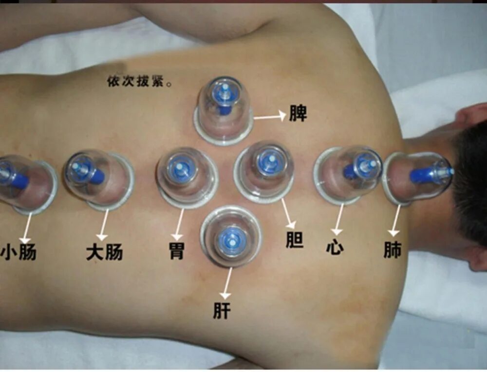 Действие банок. Точки для постановки вакуумных банок. Точки постановки банок на спину.
