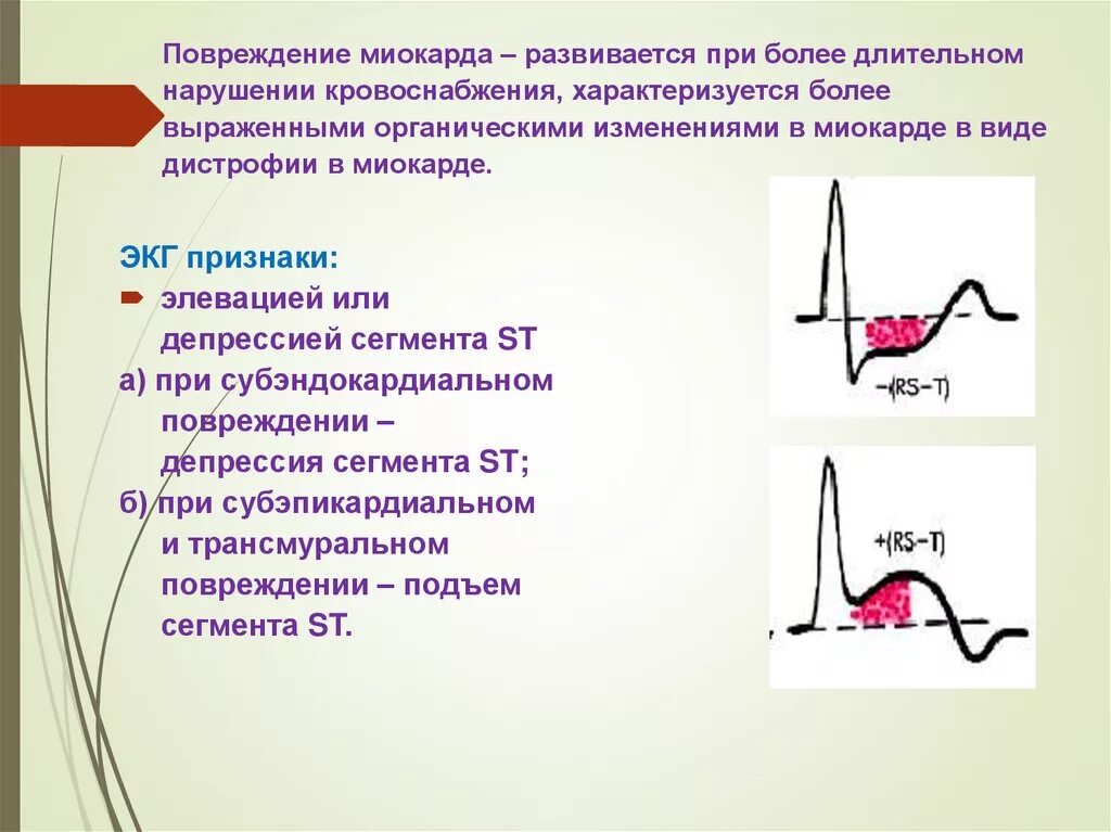 St ишемия. ЭКГ при ишемическом повреждении миокарда. ЭКГ критерии повреждения миокарда. Признаки повреждения миокарда на ЭКГ. Субэндокардиальная ишемия на ЭКГ.