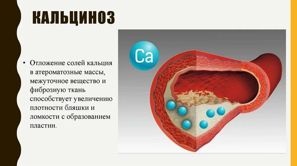 Плотный наблюдаться. Отложение солей кальция. Отложение кальция в сосудах. Отложение кальциевых солей.