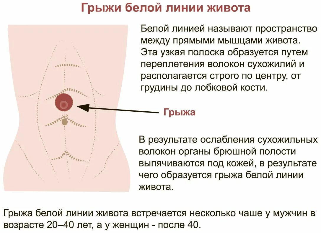 Грыжа белой линии живота анатомические предпосылки. Подпупочная грыжа белой линии живота. Гоыжа белой линиижиаота. Грыжа бедойлинии живота. Беременность боли выше пупка