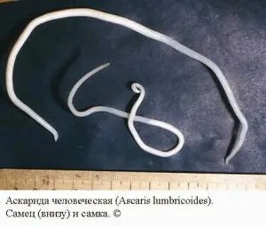 Хронический аскаридоз