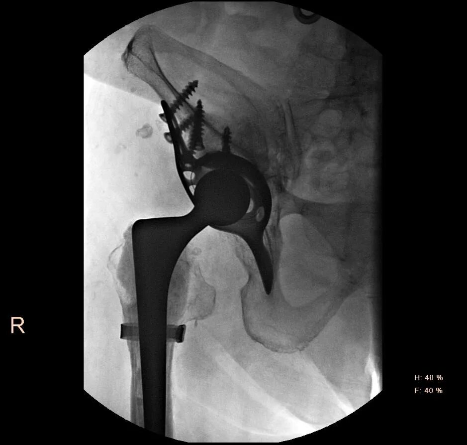 Тазобедренный сустав операция показать. Ревизионное эндопротезирование тазобедренного сустава. Эндопротезирование тазобедренного сустава операция. Ревизия тазобедренного эндопротеза. Ревизионные операция эндопротезирования тазобедренного сустава.
