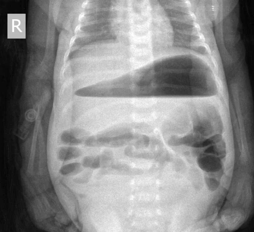 Инородное тело брюшной полости после операции. Пилоростеноз у новорожденных рентген. Пилоростеноз на рентгенограмме. Перитонит на рентгене брюшной полости. Рентген брюшной полости снимки.