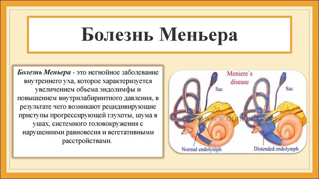 Нарушение внутреннего уха. Болезнь Меньера гидропс. Слуховая и вестибулярная системы, синдромология. Синдром Меньера.. Болезни внутреннего уха Меньера. Болезнь Меньера этиология.