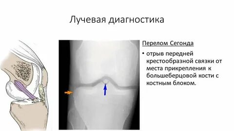 Повреждение надколенника