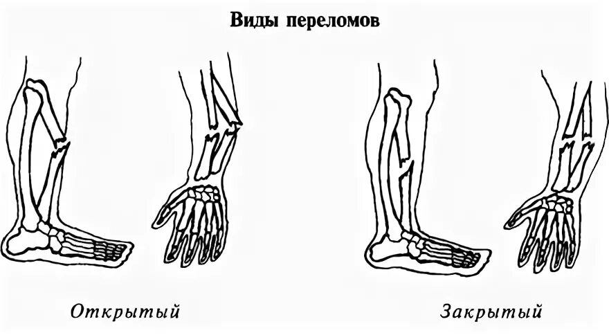 Типы закрытых переломов. Переломы костей закрытый открытый. Открытый и закрытый перелом схема. Схема открытого и закрытого перелома. Переломы костей верхних конечностей (закрытые и открытые):.