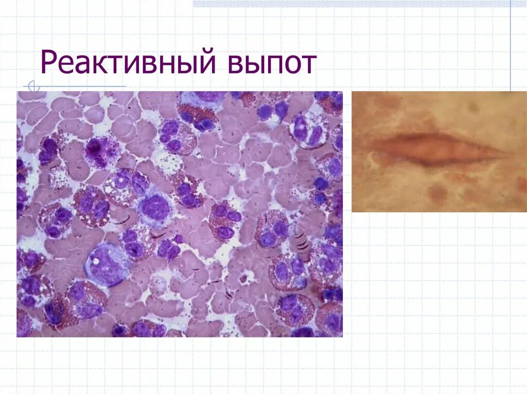Дегенеративные изменения цитограмма