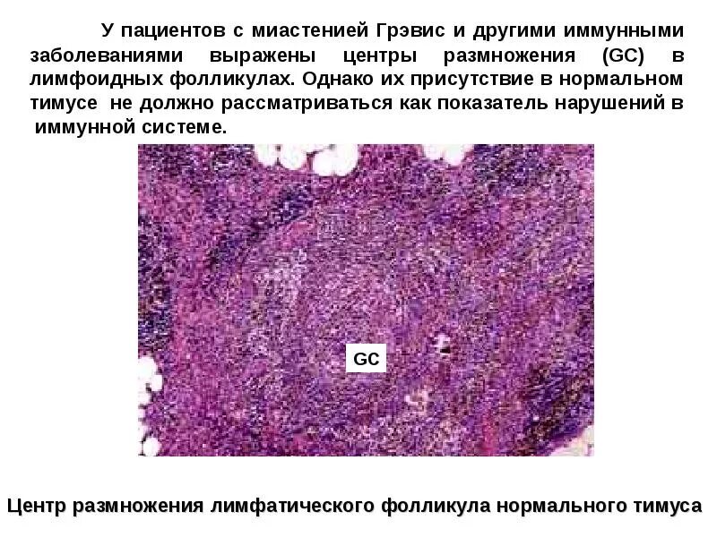 Реактивная гиперплазия лимфатических узлов гистология. Фолликулярная лимфома микропрепарат. Фолликулярная гиперплазия это. Гипоплазия лимфатического узла. Гиперплазия лимфатического узла гистология.