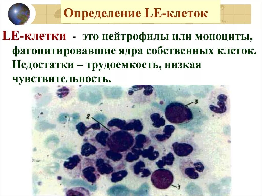 Le-клетки волчаночные клетки. Обнаружение le клеток в крови. Le клетки анализ. Le клетки красная волчанка.