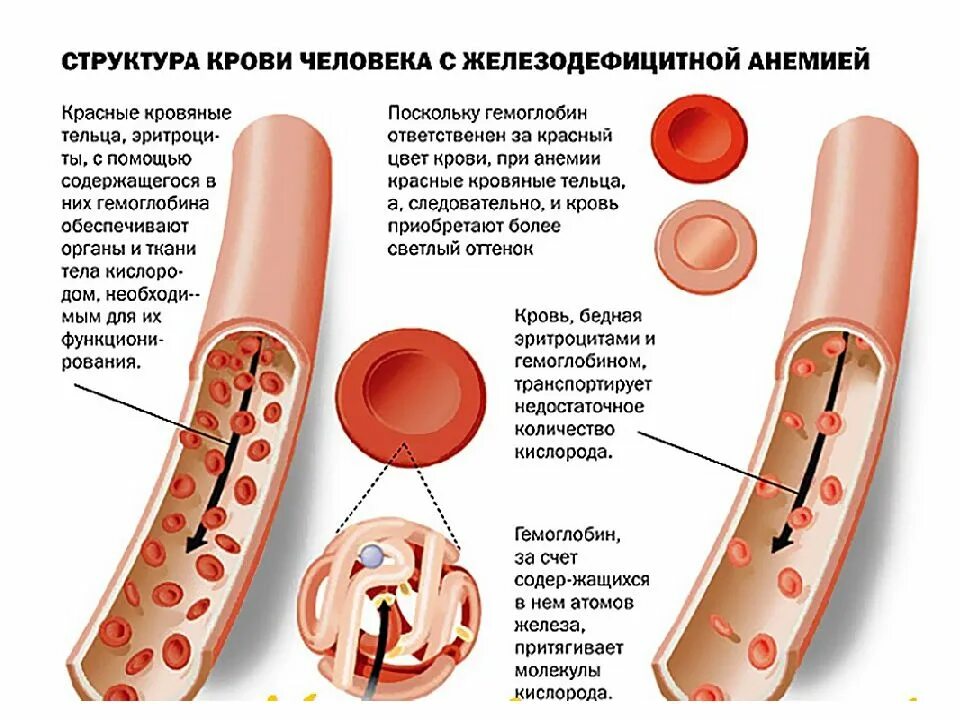 Как определить заболевание крови. Структура крови человека с железодефицитной анемией. Железо крови при железодефицитной анемии. Железодефицитная анемия симптомы. Железодефицитная анемия картинки.