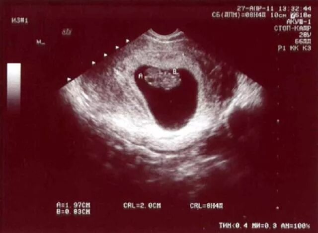 Беременность 9 недель развитие плода фото. 9 Недель беременности УЗИ размер плода. 8-9 Недель беременности размер плода. Эмбрион на 9 неделе беременности УЗИ. 9 неделя б