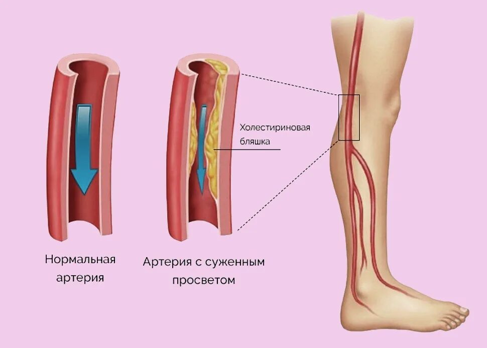 Почему хромает нога. Облитерирующий атеросклероз вен нижних конечностей. Облитерирующий атеросклероз артерий нижних конечностей. Облитерирующий атеросклероз сосудов конечностей. Облитерирующий атеросклероз осложнения.
