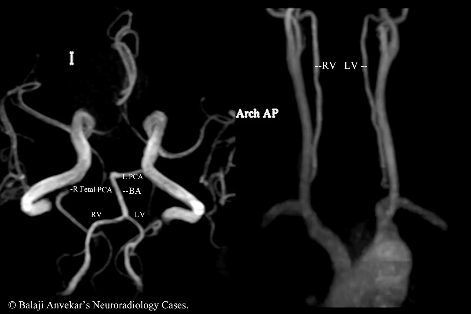 Гипоплазия червя. Глоссарий Radiology. Vertebral Vein Imaging with Mr Angiography.