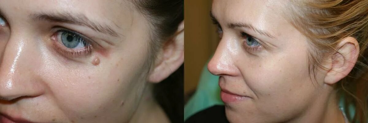 Шрам от родинки на лице. Останется ли в стрелка если к ней приблизить проводник. То ради чего. Останется ли в покое магнитная стрелка вблизи проводника с током. Пигментные пятна постакне.