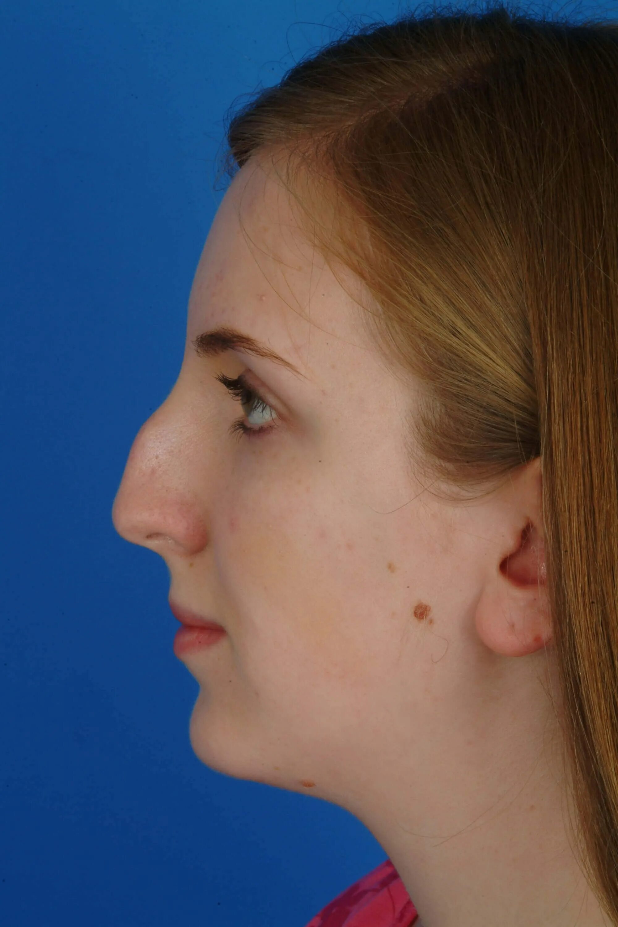 красивый нос с горбинкой. ринопластика орлиного носа. костно хрящевая горбинка носа. ринопластика кончика носа. нос с небольшой горбинкой.