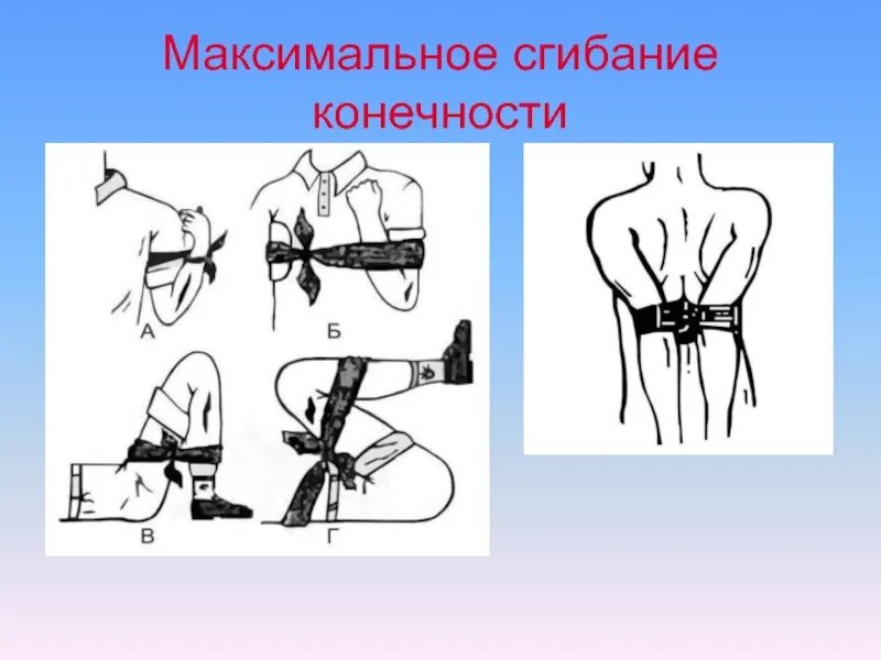 Остановка кровотечения путем сгибания конечности. Максимальное сгибание конечности. Максимальное сгибание конечности в суставе. Метод максимального сгибания конечности. Максимальное фиксированное сгибание конечности в суставе.