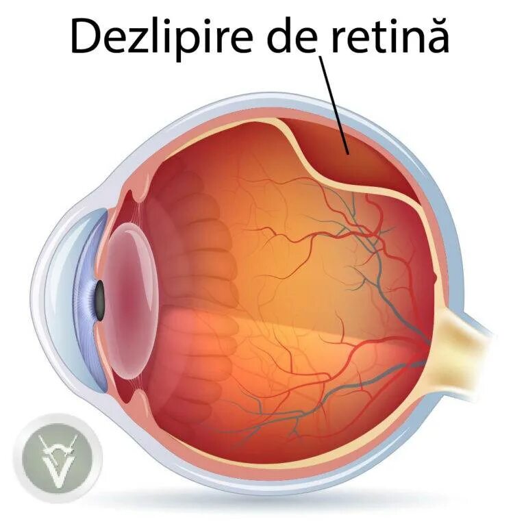 Отслойка сетчатки глаза. Отслоение сетчатки глаза симптомы. Неопластическая отслойка сетчатки. Тотальная воронкообразная отслойка сетчатки.