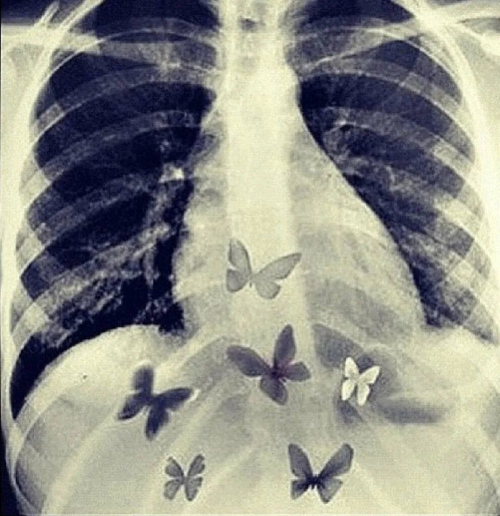 Бабочки в животе. Бабочки в животе рентген. Бабочки в легких рентген. Снимок легких с бабочками. Бабочки в моем животе это любовь