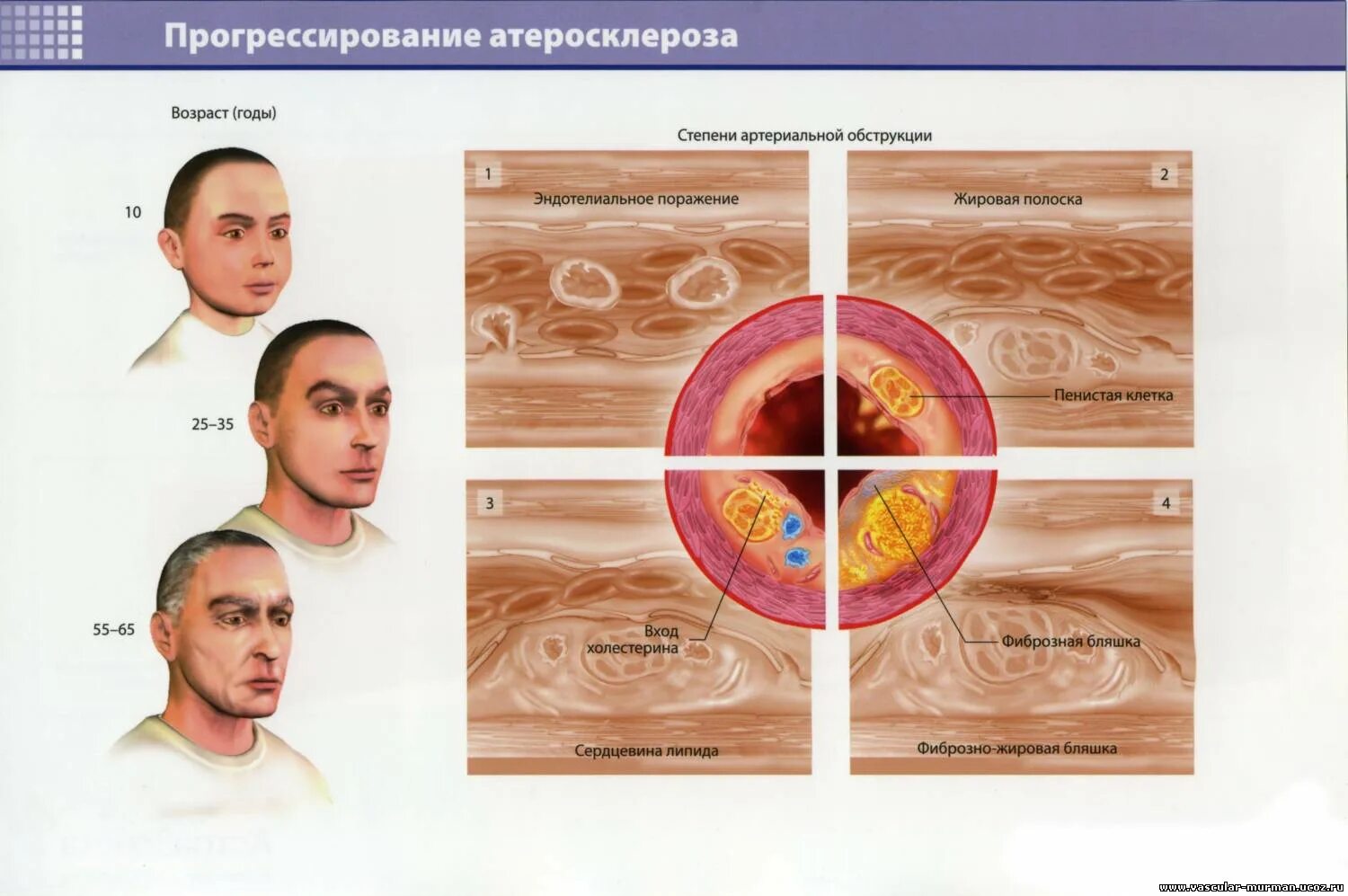 Возрастные сосудистые изменения. Внешность человека с атеросклерозом.