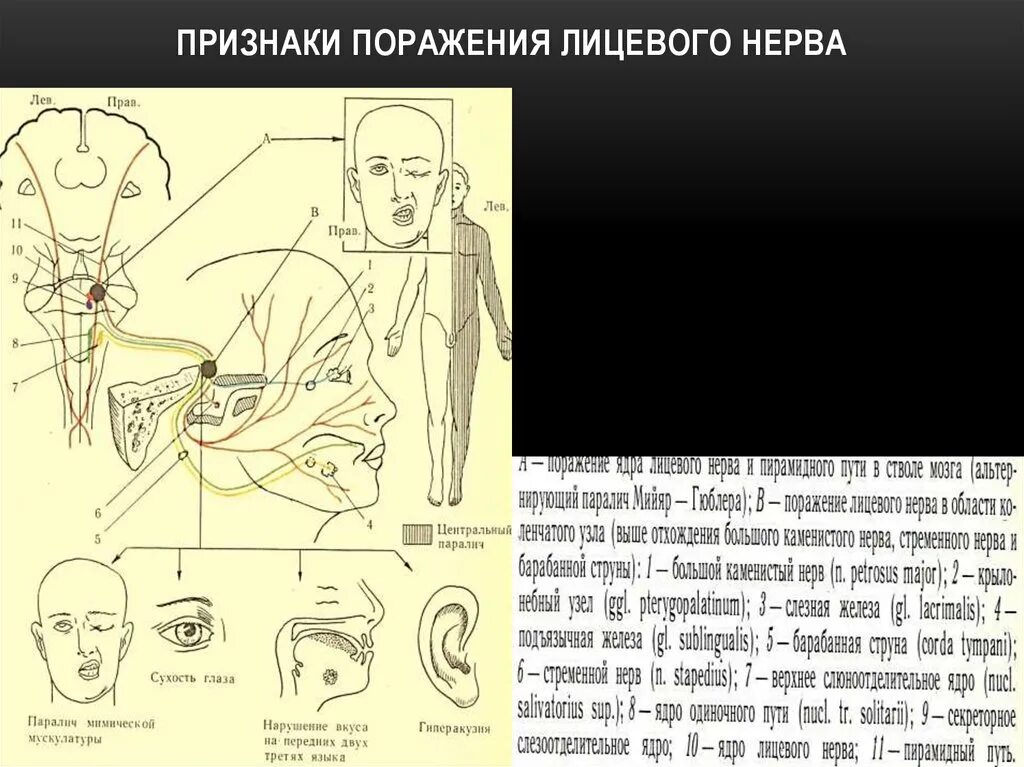 Правый лицевой нерв. Синдром периферического поражения лицевого нерва. Порангие лицевого нерва. Уровни повреждения лицевого нерва. Симптомы поражения лицевого нерва неврология.