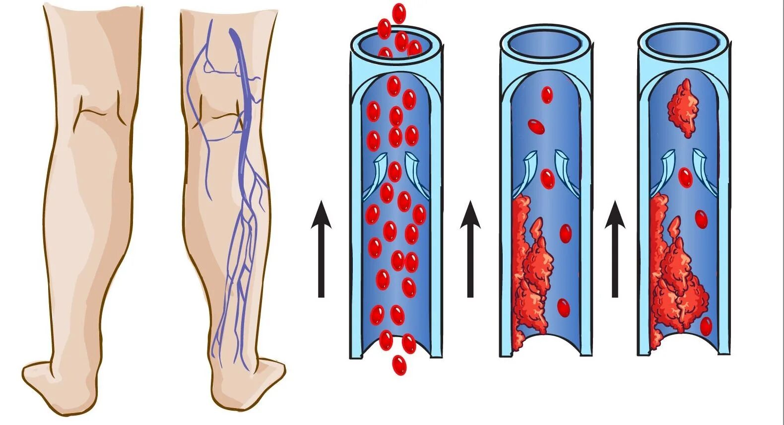 Причины тромбов симптомы. Острый тромбоз глубоких вен бедра. Флебит тромбофлебит глубоких вен. Флеботромбоз глубоких вен нижних конечностей. Острый тромбофлебит поверхностных и глубоких вен.