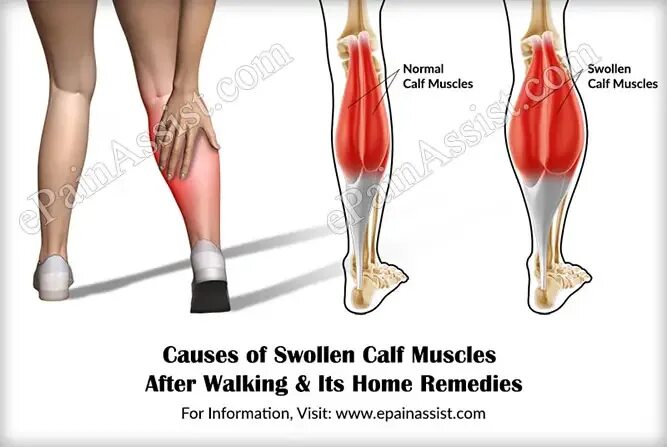 плечелопаточный периартрит. воспаление мышц миозит. эпидемическая миалгия. симптомы мышечной боли. спазм грушевидной мышцы.